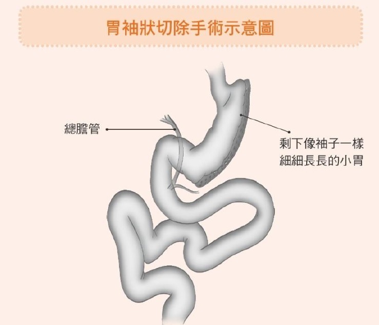 胃袖狀切除手術示意圖