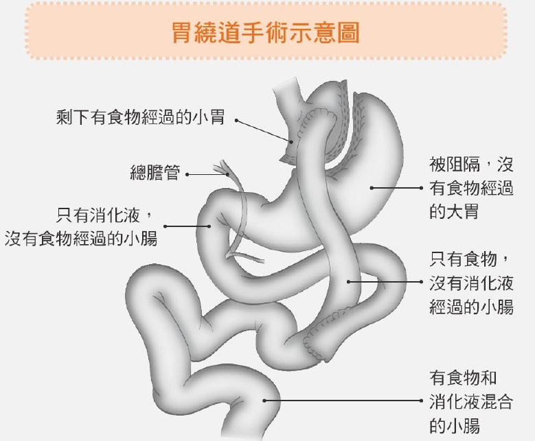 胃繞道手術示意圖