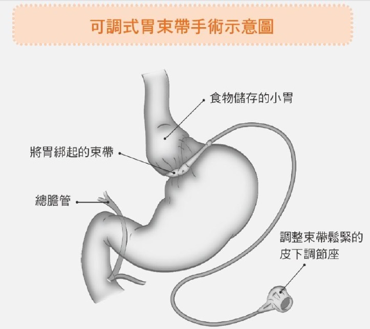 可調式胃束帶手術示意圖