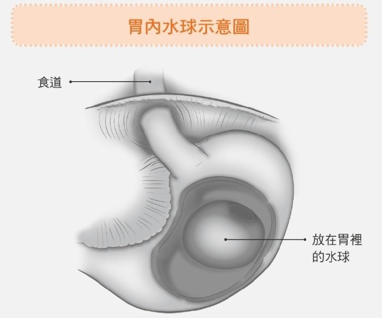 胃內水球示意圖
