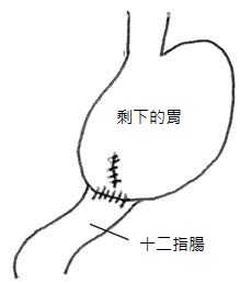 畢羅氏第一型吻合術