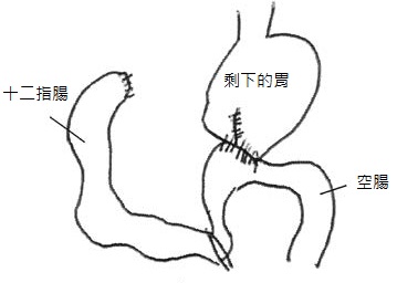 畢羅氏第二型吻合術