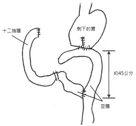 Y型空腸吻合術