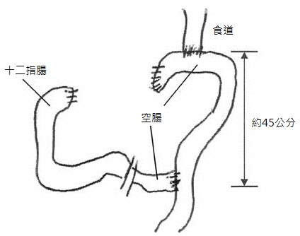 全為切除-Y型空腸吻合術